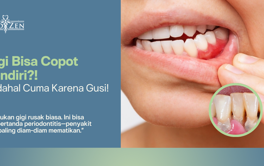 Waspadai Periodontitis: Penyakit Gusi yang Bisa Bikin Gigi Copot Tanpa Dicabut!