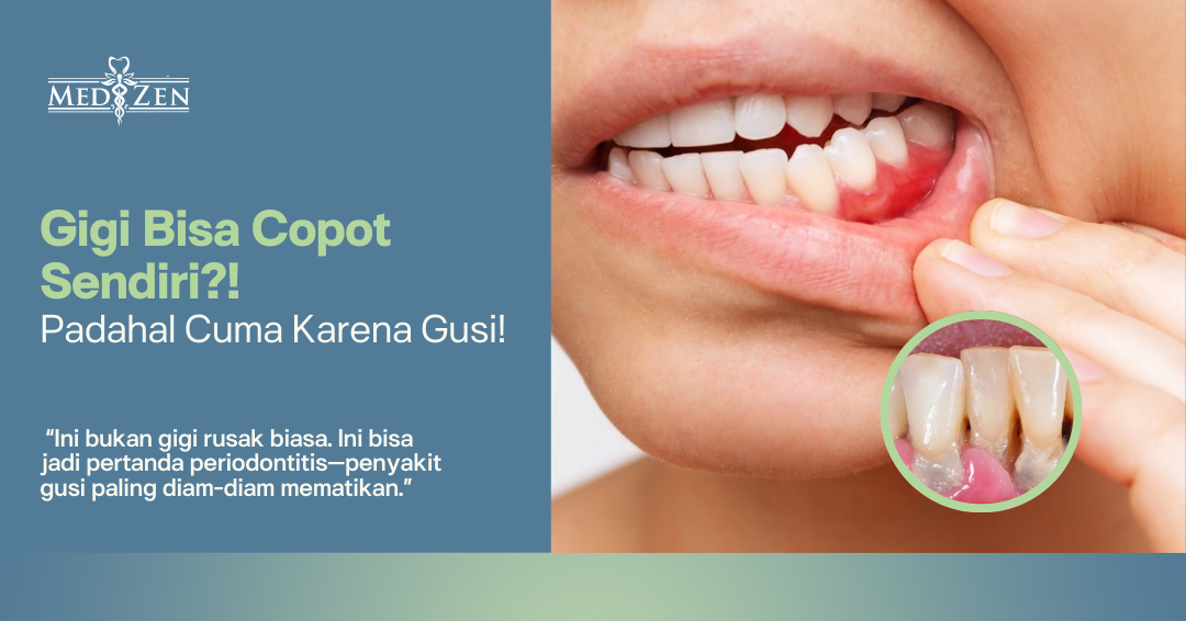 Waspadai Periodontitis: Penyakit Gusi yang Bisa Bikin Gigi Copot Tanpa Dicabut!