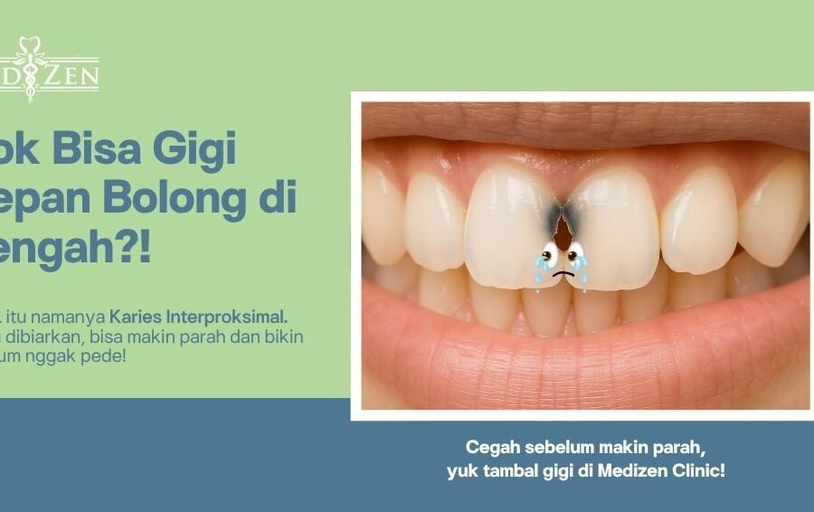 Karies Interproksimal: Si Gigi Bolong yang Sering Terabaikan di Tengah Dua Gigi Depan