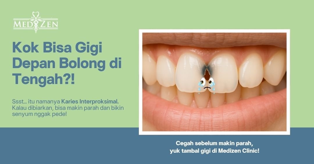 Karies Interproksimal: Si Gigi Bolong yang Sering Terabaikan di Tengah Dua Gigi Depan