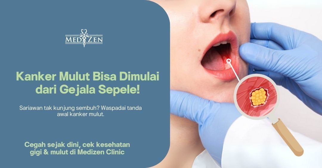 Kanker Mulut: Gejala, Penyebab, dan Pentingnya Deteksi Dini