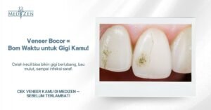 Apakah Veneer Bocor Itu Berbahaya?