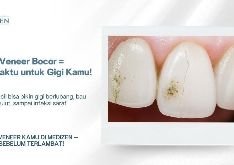 Apakah Veneer Bocor Itu Berbahaya?