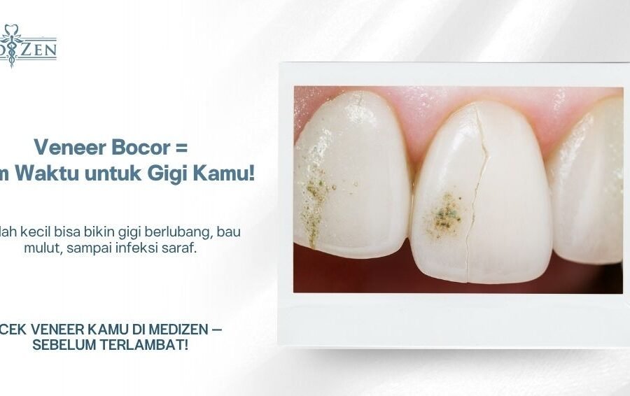 Apakah Veneer Bocor Itu Berbahaya?
