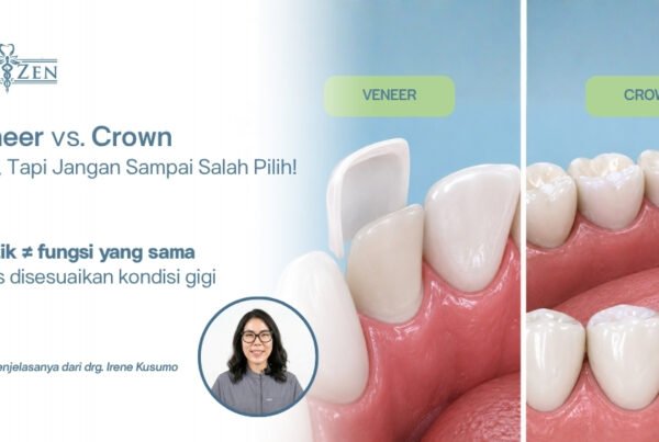 drg. Irene Kusumo Medizen Clinic Jakarta Selatan menjelaskan perbedaan veneer dan crown gigi