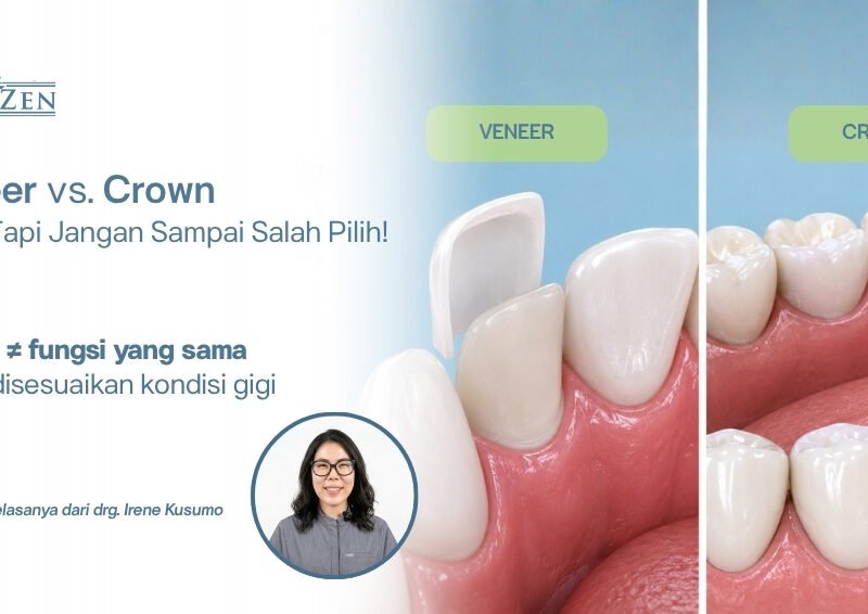 drg. Irene Kusumo Medizen Clinic Jakarta Selatan menjelaskan perbedaan veneer dan crown gigi